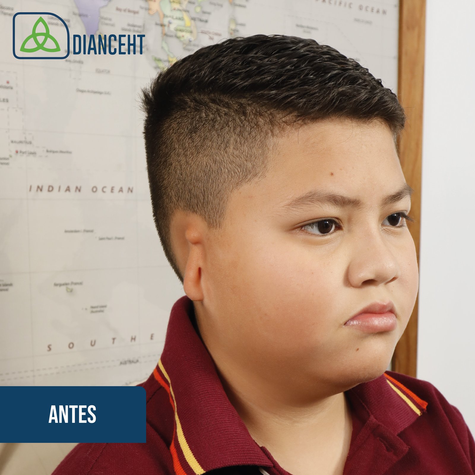 Antes - Microtia